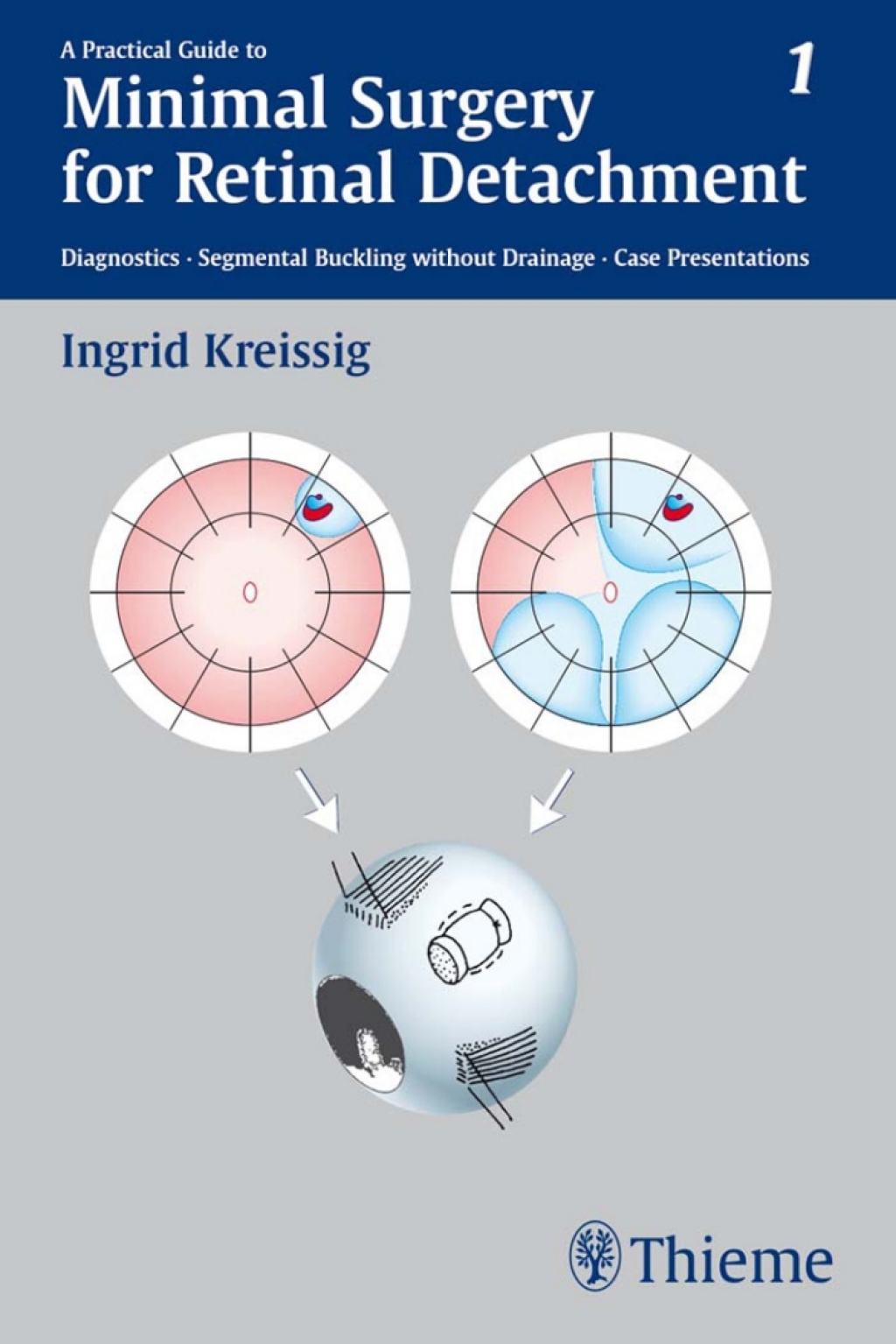 A Practical Guide to Minimal Surgery for Retinal Detachment, Vol. 1 Diagnostics, Segmental Buckling without Drainage, Case Presentations 1st Edition â€“ PDF/EPUB Version Downloadable