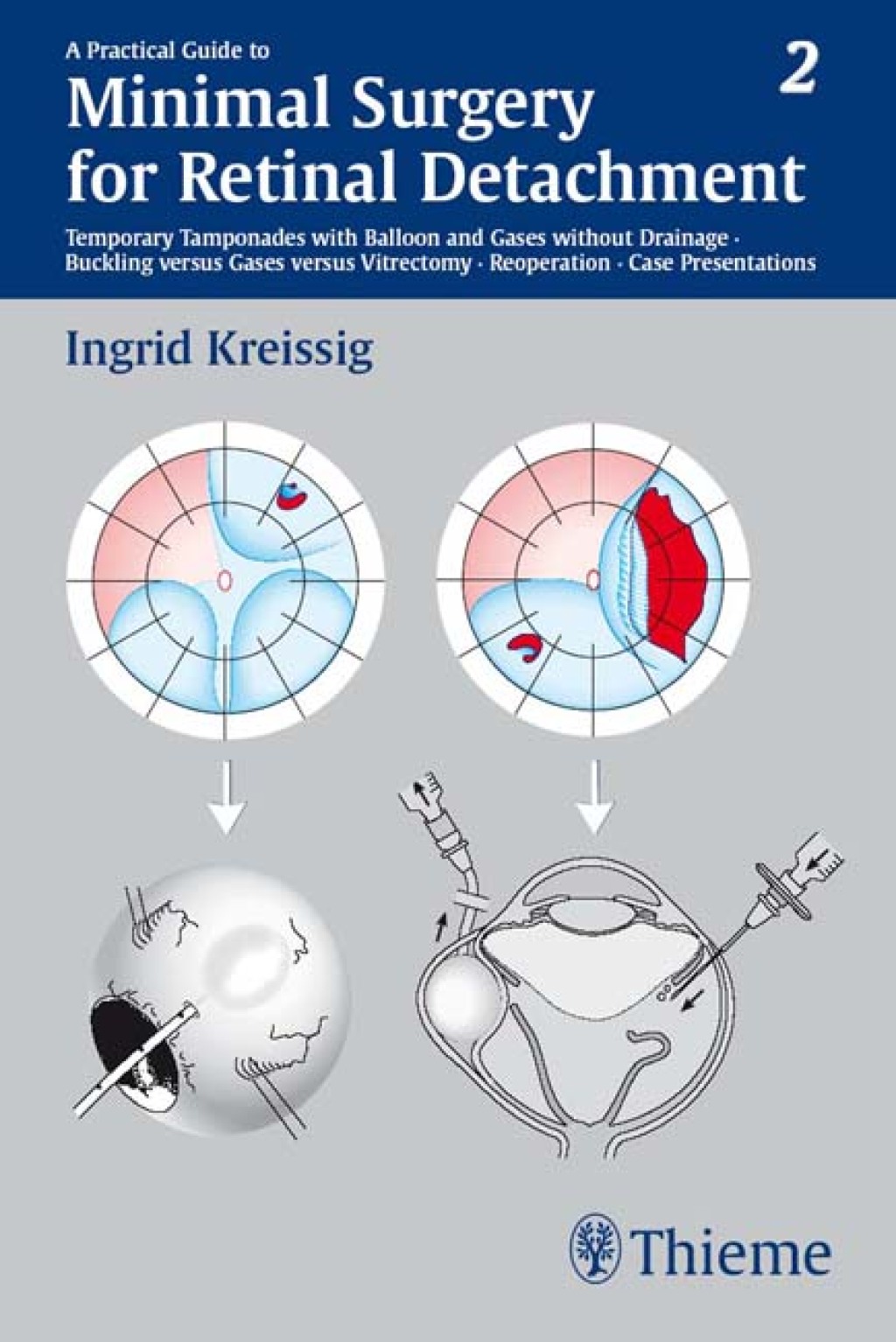 A Practical Guide to Minimal Surgery for Retinal Detachment, Vol. 2 Temporary Tamponades with Balloon and Gases without Drainage, Buckling versus Gases versus Vitrectomy, Reoperation, Case Presentations 1st Edition â€“ PDF/EPUB Version Downloadable