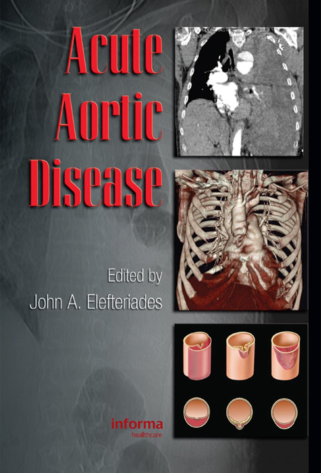 Acute Aortic Disease 1st Edition â€“ PDF/EPUB Version Downloadable