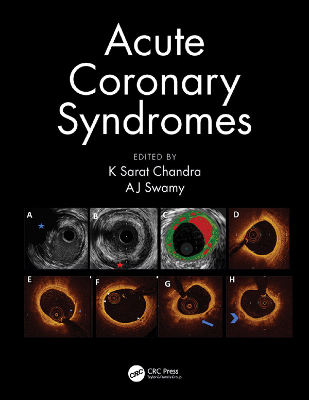 Acute Coronary Syndromes 1st Edition â€“ PDF/EPUB Version Downloadable