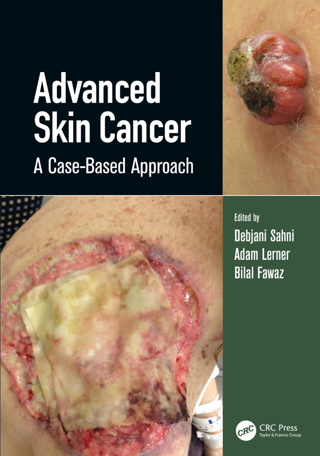 Advanced Skin Cancer A Case-Based Approach 1st Edition â€“ PDF/EPUB Version Downloadable