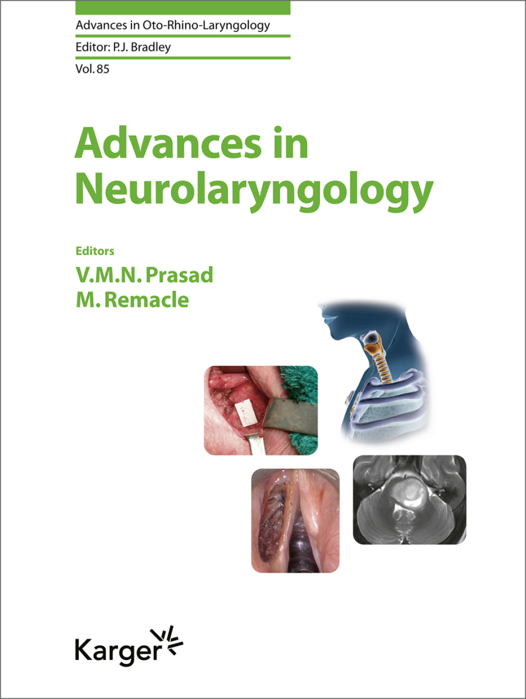 Advances in Neurolaryngology 1st Edition â€“ PDF/EPUB Version Downloadable
