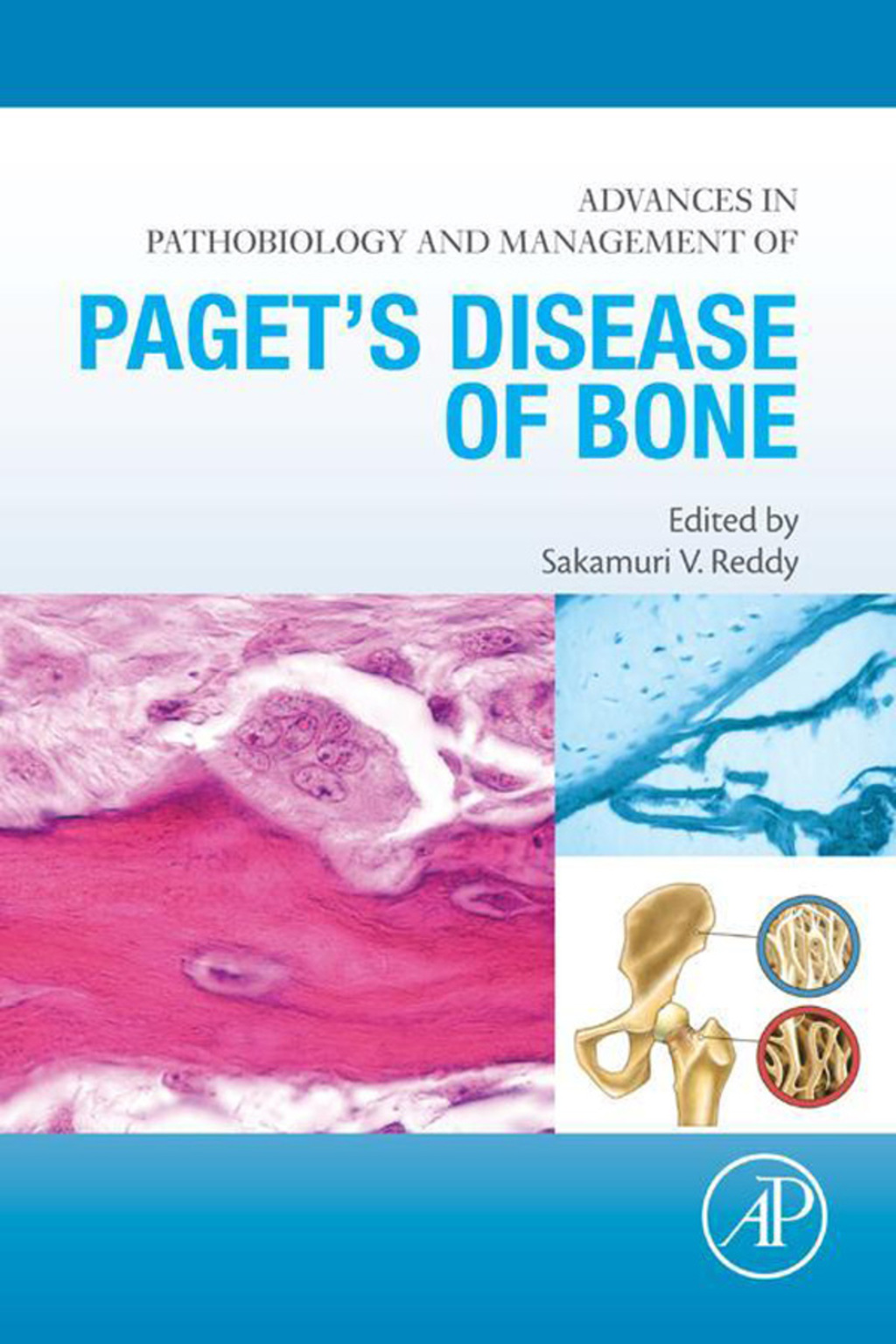 Advances in Pathobiology and Management of Pagetâ€™s Disease of Bone â ...