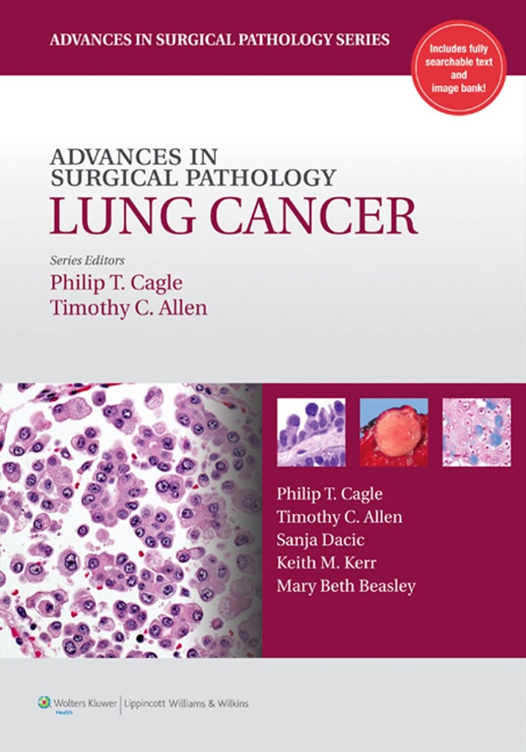 Advances in Surgical Pathology: Lung Cancer 1st Edition â€“ PDF/EPUB Version Downloadable
