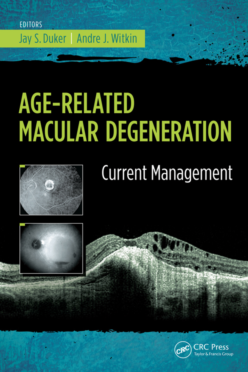 Age-Related Macular Degeneration Current Management 1st Edition â€“ PDF/EPUB Version Downloadable