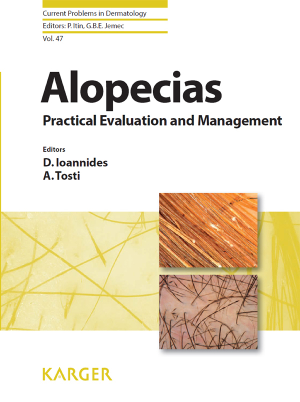 Alopecias - Practical Evaluation and Management 1st Edition â€“ PDF/EPUB Version Downloadable