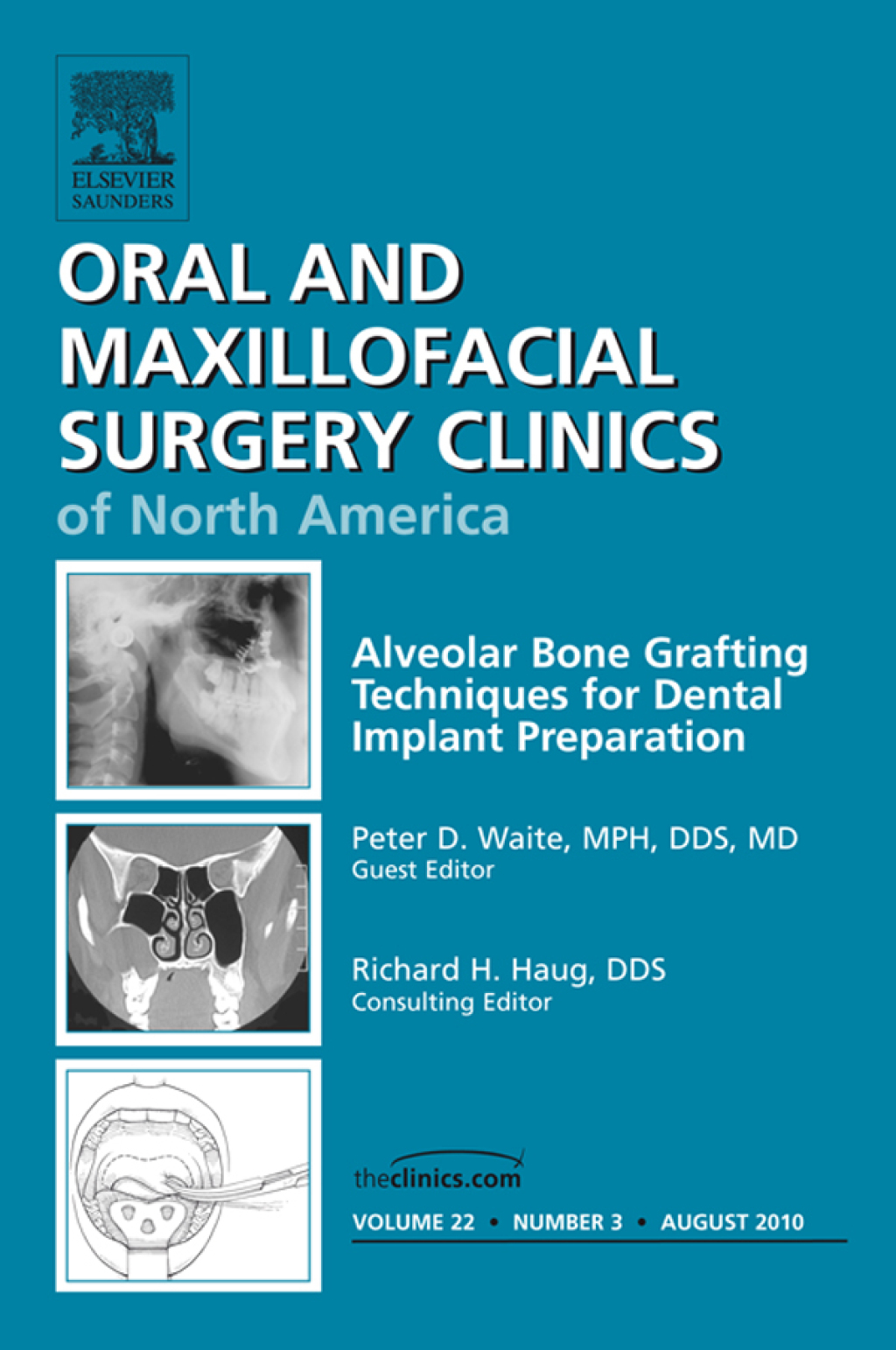 Alveolar Bone Grafting Techniques in Dental Implant Preparation, An ...