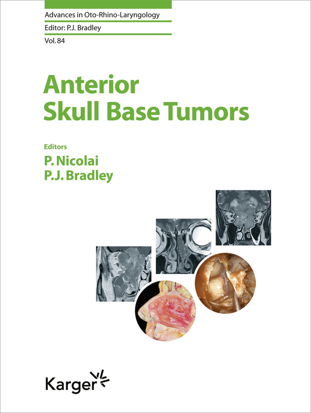 Anterior Skull Base Tumors 1st Edition â€“ PDF/EPUB Version ...