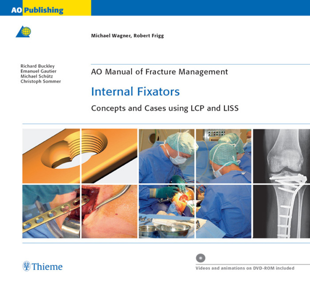 AO Manual of Fracture Management: Internal Fixators Concepts and Cases using LCP and LISS 1st Edition â€“ PDF/EPUB Version Downloadable