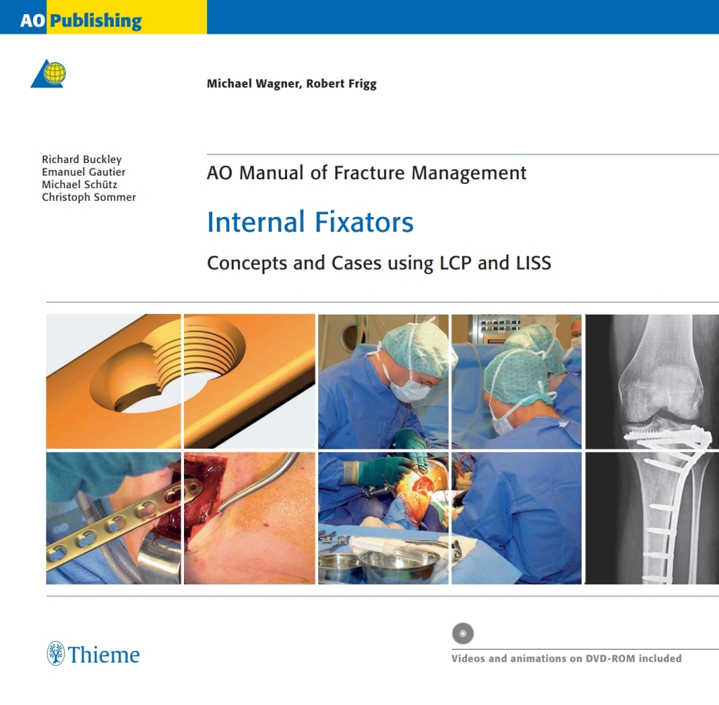 AO Manual of Fracture Management: Internal Fixators Concepts and Cases using LCP and LISS 1st Edition – PDF/EPUB Version Downloadable AO Manual of Fracture Management: Internal Fixators Concepts and Cases using LCP and LISS 1st Edition – PDF/EPUB Version Downloadable - Image 1