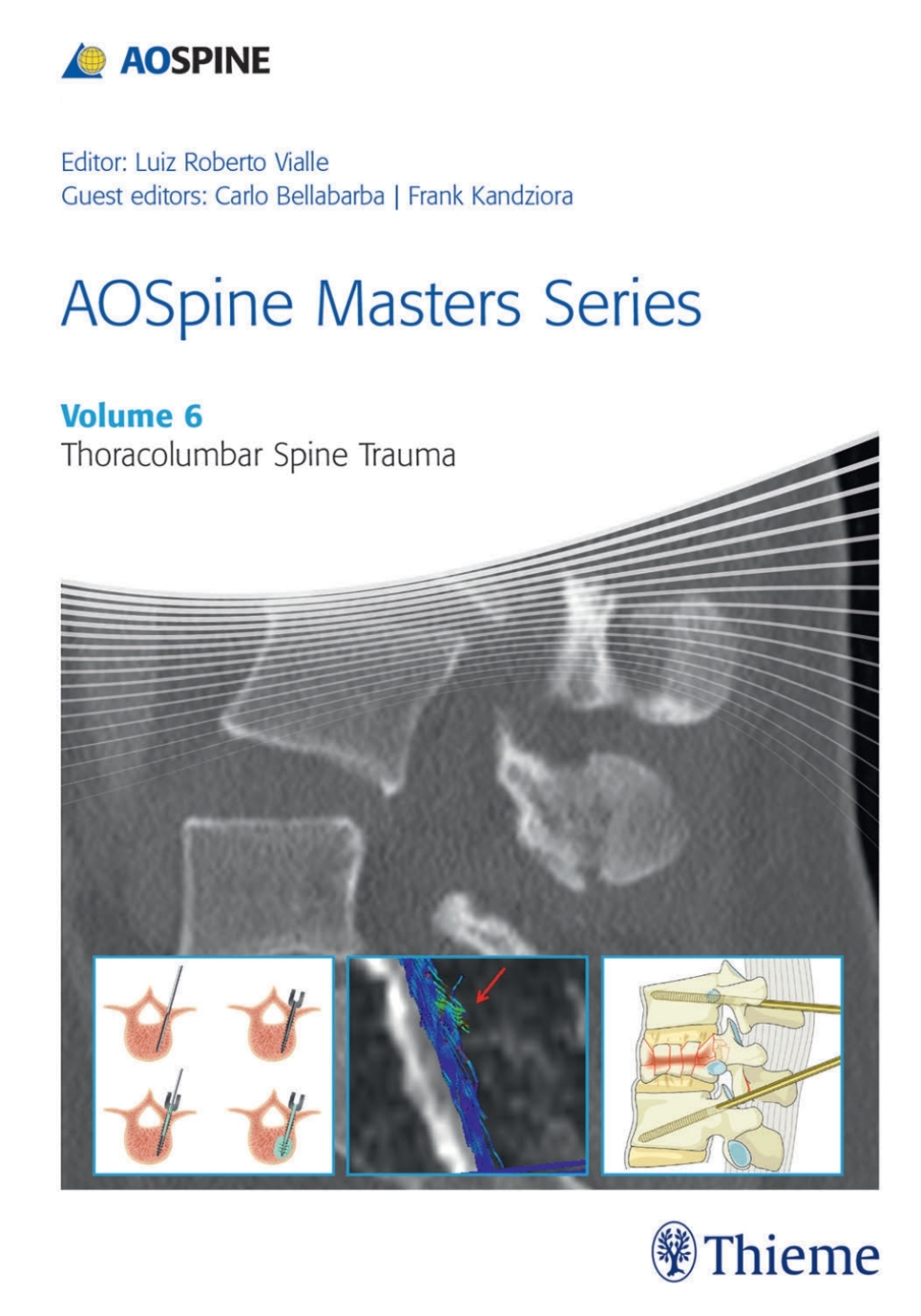 AOSpine Masters Series, Volume 6: Thoracolumbar Spine Trauma 1st Edition â€“ PDF/EPUB Version Downloadable