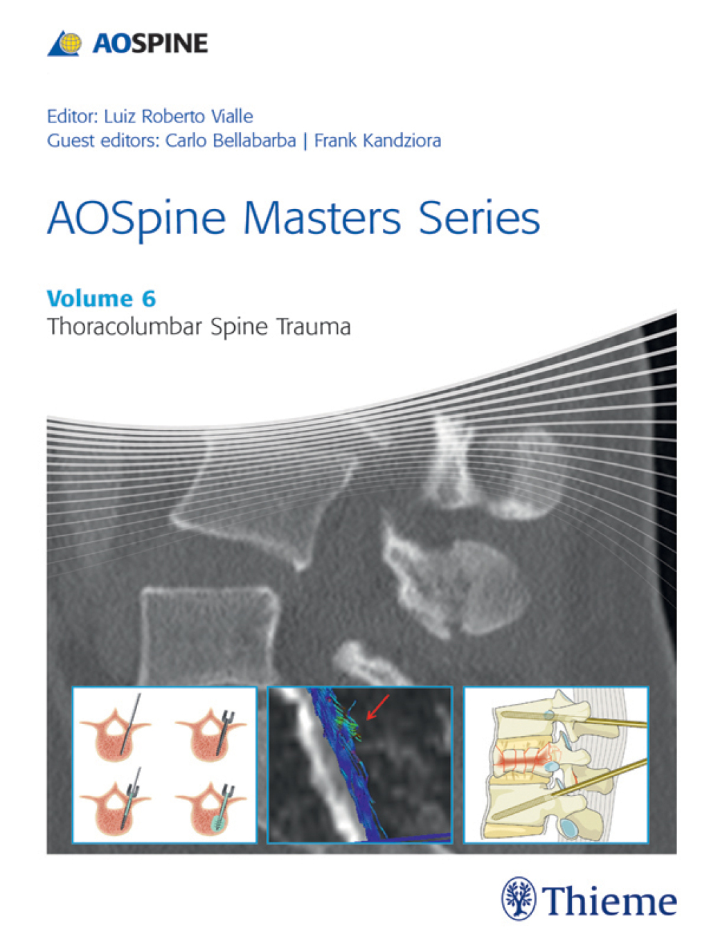 AOSpine Masters Series, Volume 6: Thoracolumbar Spine Trauma 1st Edition â€“ PDF/EPUB Version Downloadable
