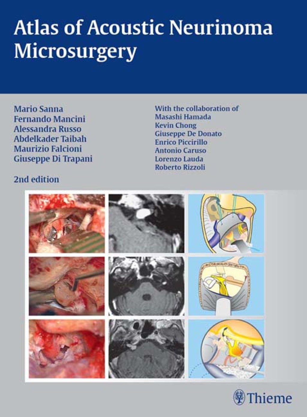 Atlas of Acoustic Neurinoma Microsurgery 2nd Edition â€“ PDF/EPUB Version Downloadable