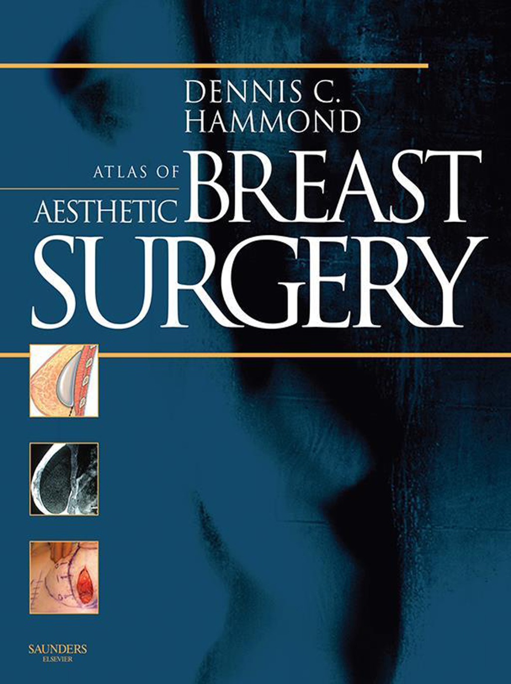 Atlas of Aesthetic Breast Surgery â€“ PDF/EPUB Version Downloadable