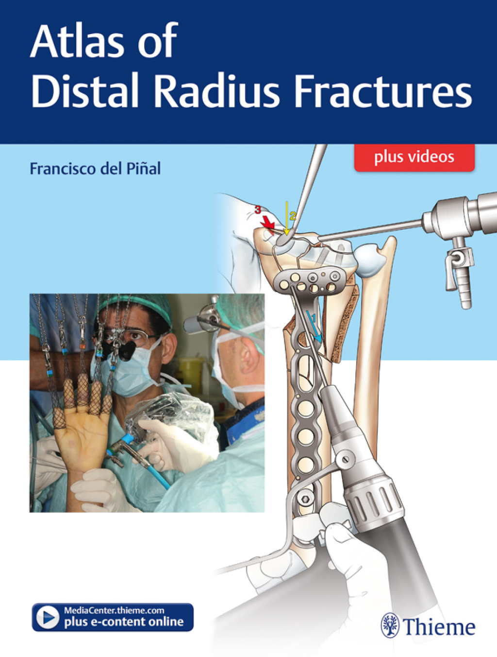 Atlas of Distal Radius Fractures 1st Edition â€“ PDF/EPUB Version Downloadable