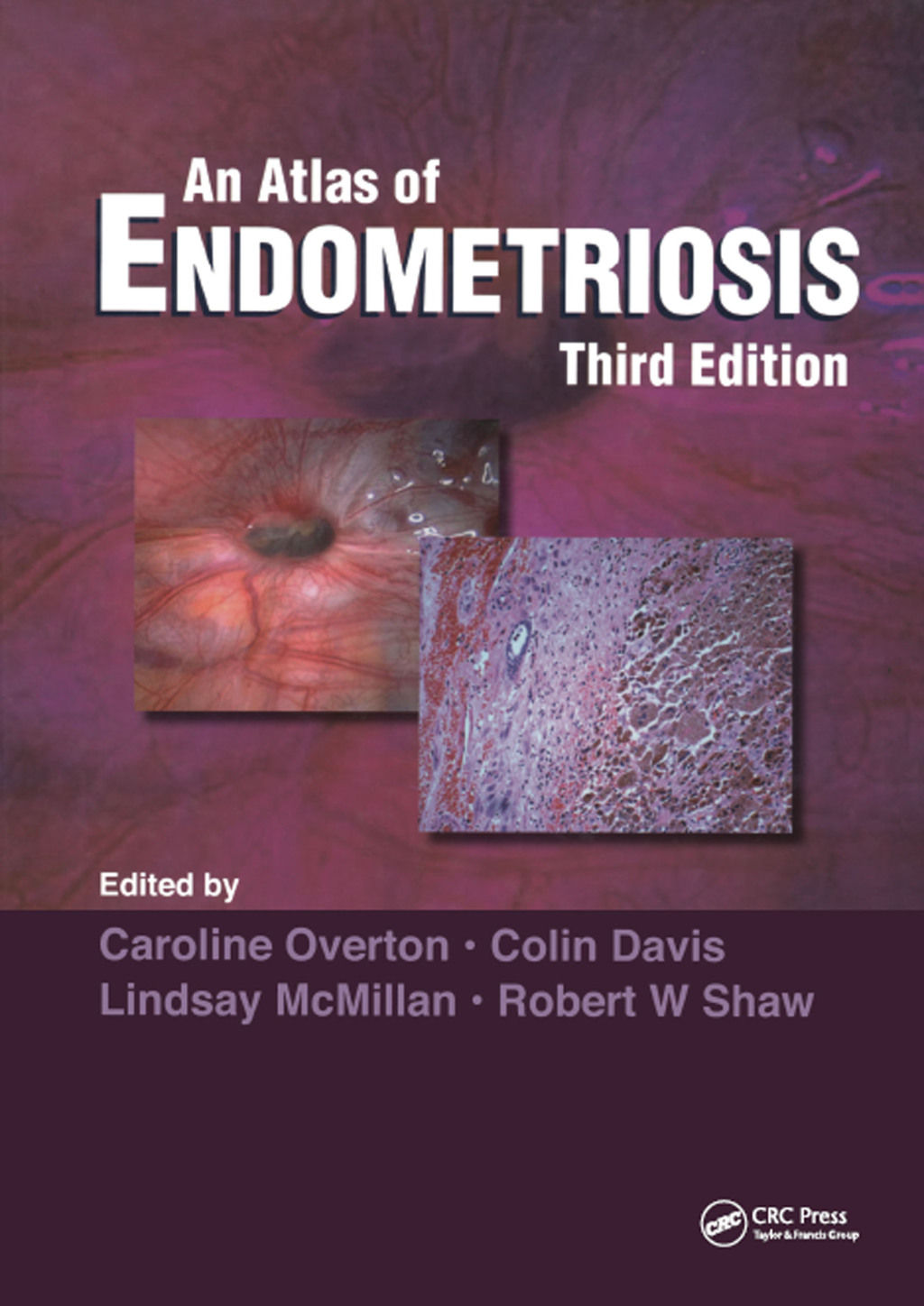Atlas of Endometriosis 3rd Edition â€“ PDF/EPUB Version Downloadable