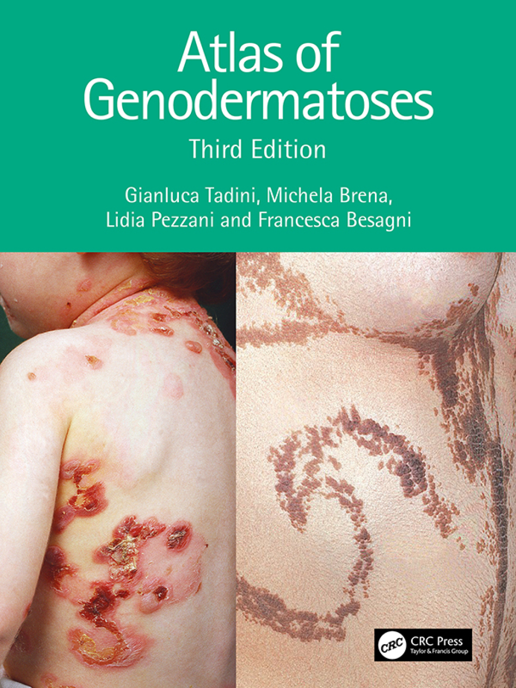 Atlas of Genodermatoses 3rd Edition â€“ PDF/EPUB Version Downloadable