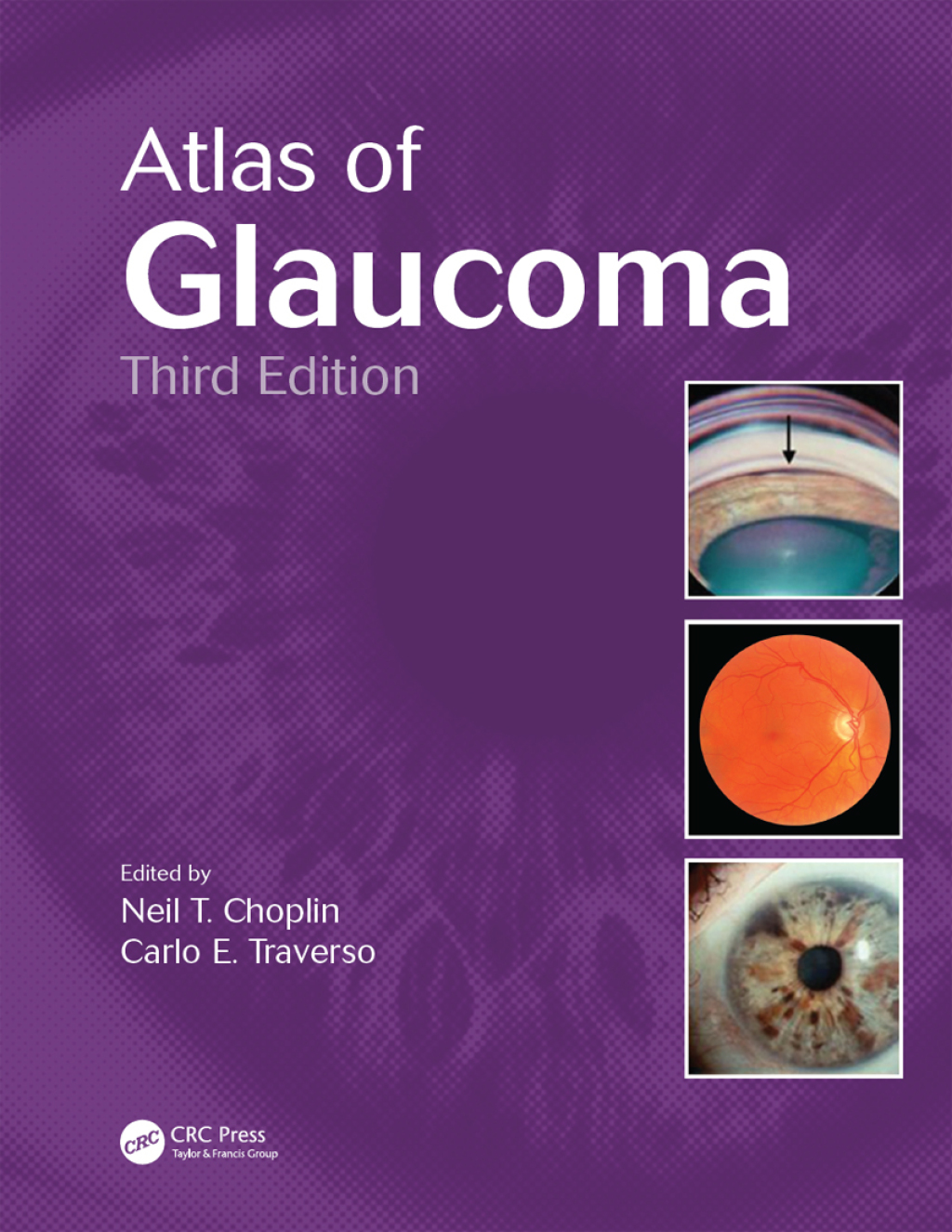 Atlas of Glaucoma 3rd Edition â€“ PDF/EPUB Version Downloadable
