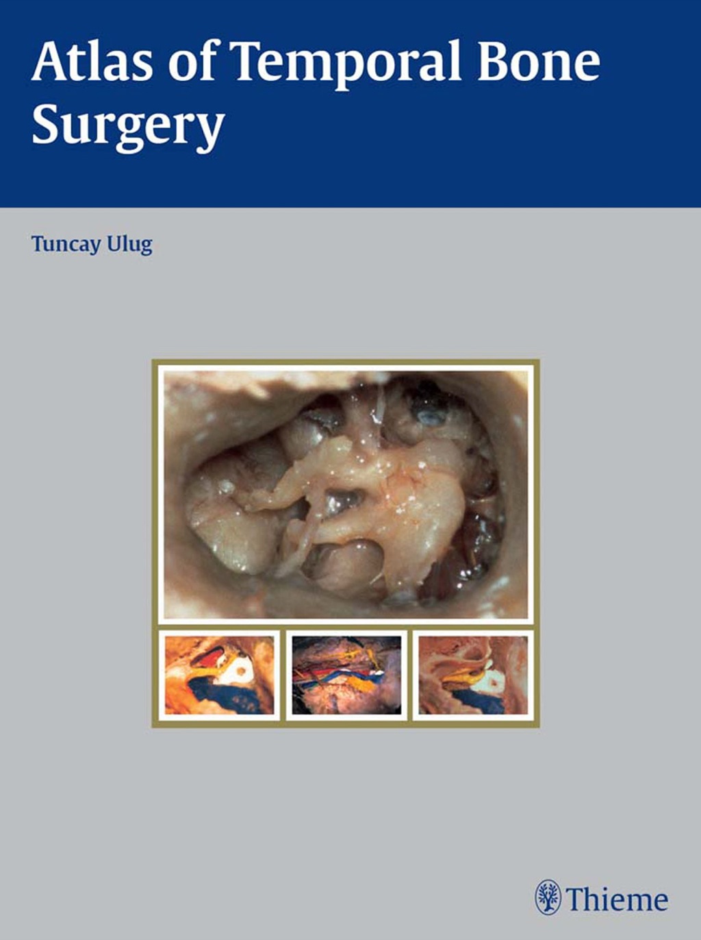 Atlas of Temporal Bone Surgery 1st Edition â€“ PDF/EPUB Version Downloadable