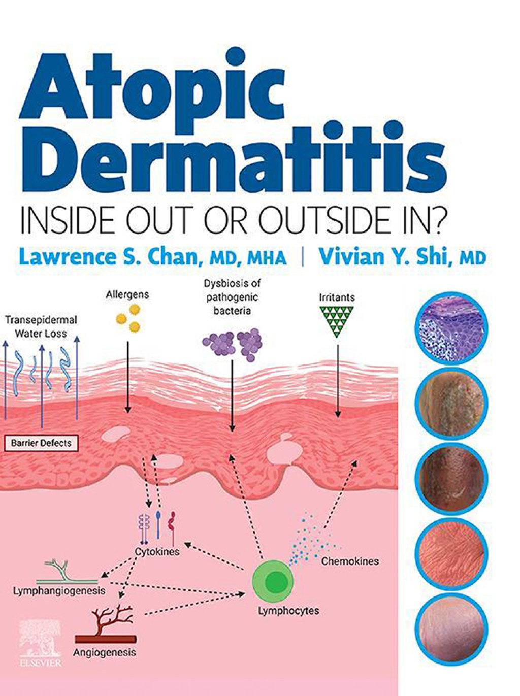Atopic Dermatitis: Inside Out or Outside In - E-Book â€“ PDF/EPUB Version Downloadable
