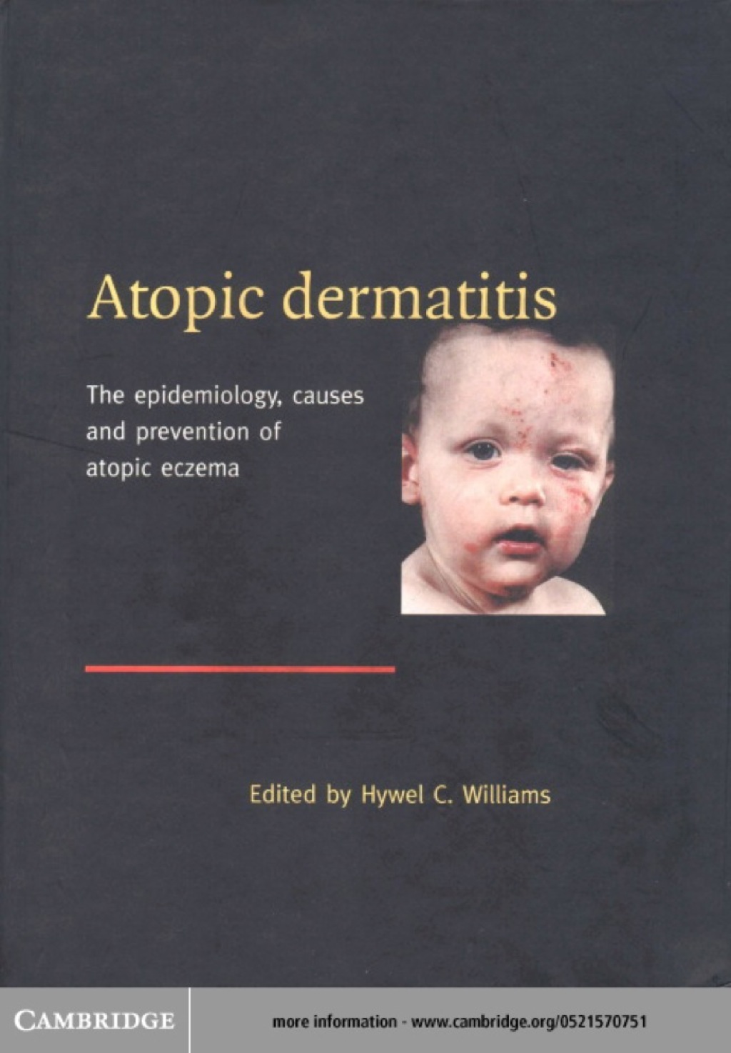 Atopic Dermatitis The Epidemiology, Causes and Prevention of Atopic Eczema 1st Edition â€“ PDF/EPUB Version Downloadable