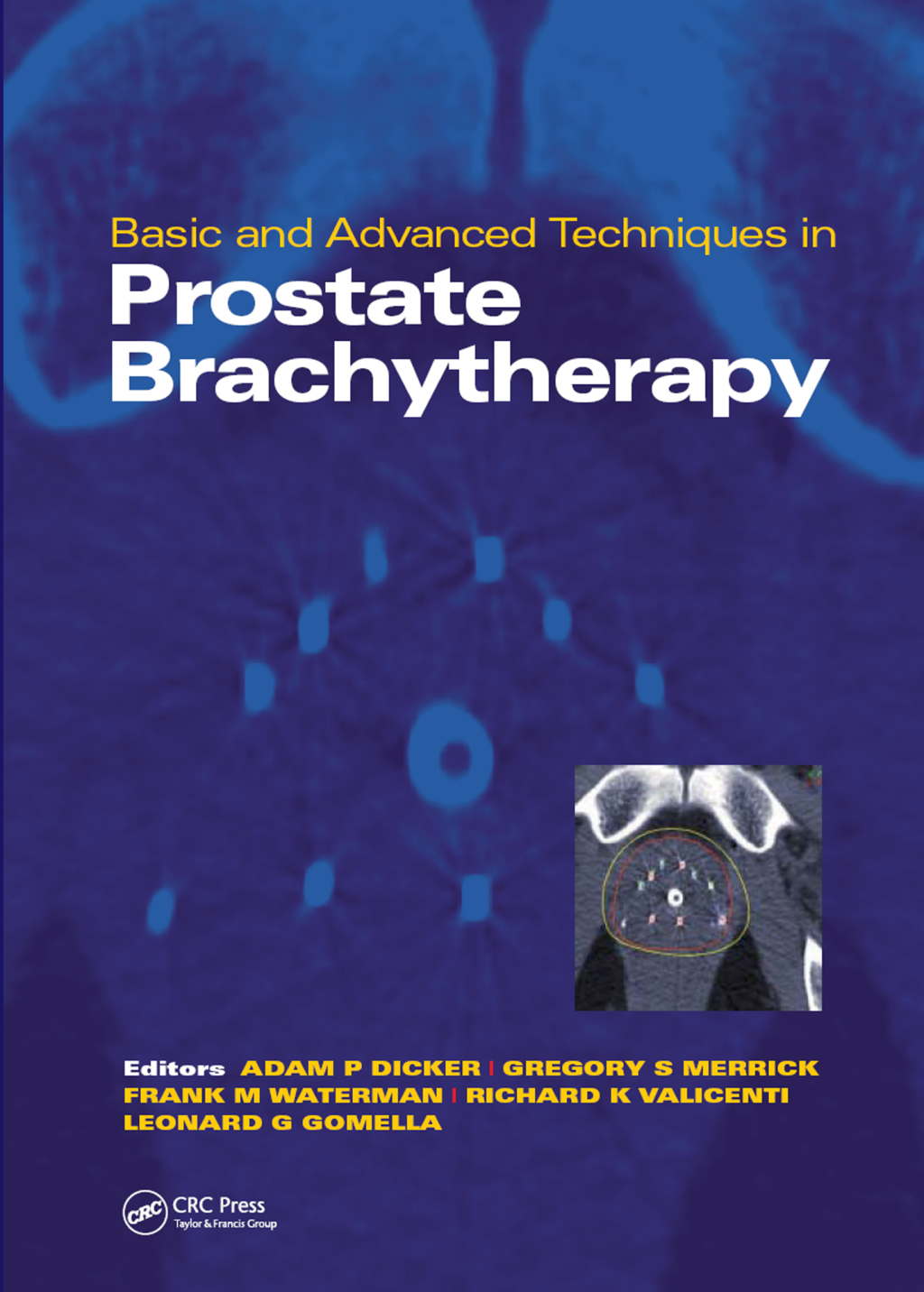 Basic and Advanced Techniques in Prostate Brachytherapy 1st Edition â€“ PDF/EPUB Version Downloadable