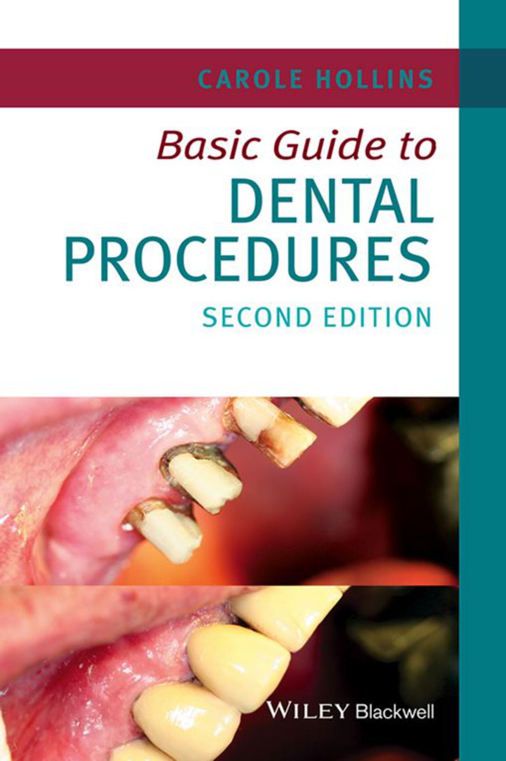 Basic Guide to Dental Procedures 2nd Edition - (PDF/EPUB Version)