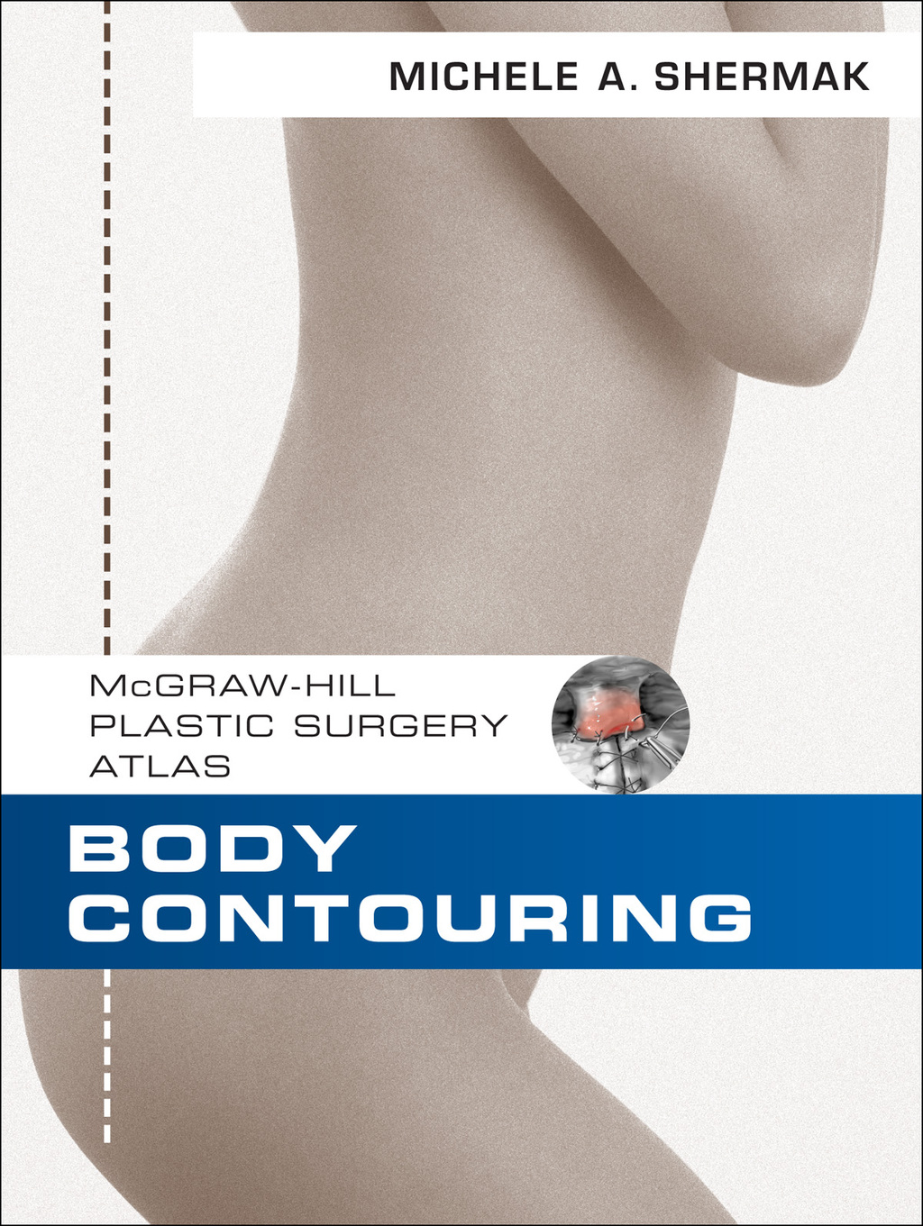 Body Contouring 1st Edition – PDF/EPUB Version Downloadable Body Contouring 1st Edition – PDF/EPUB Version Downloadable - Image 1