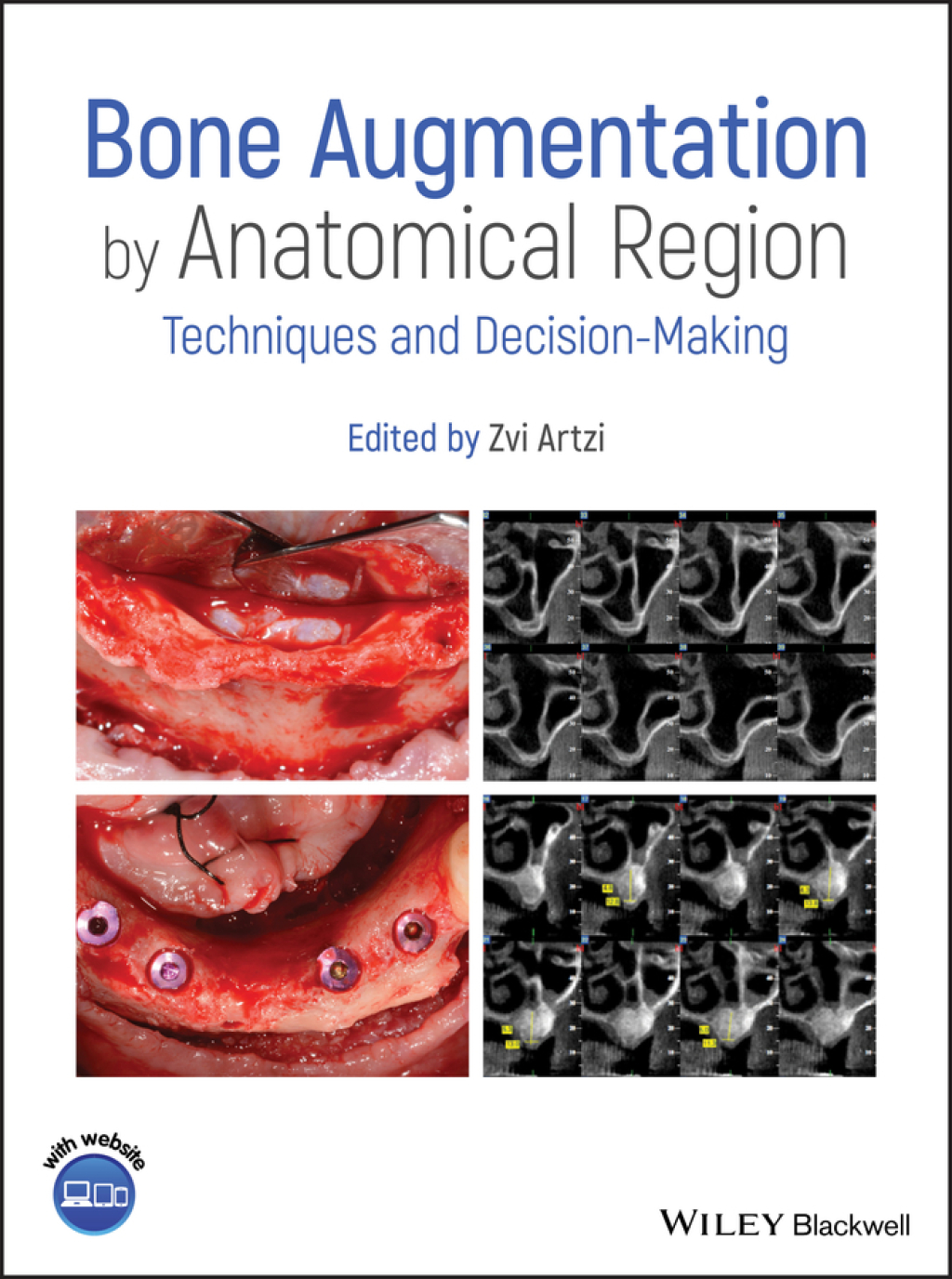 Bone Augmentation by Anatomical Region Techniques and Decision-Making ...
