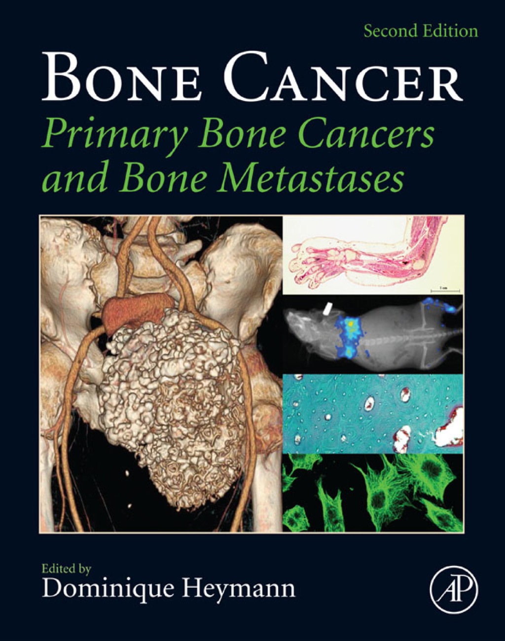 Bone Cancer: Primary Bone Cancers and Bone Metastases 2nd Edition â€“ PDF/EPUB Version Downloadable