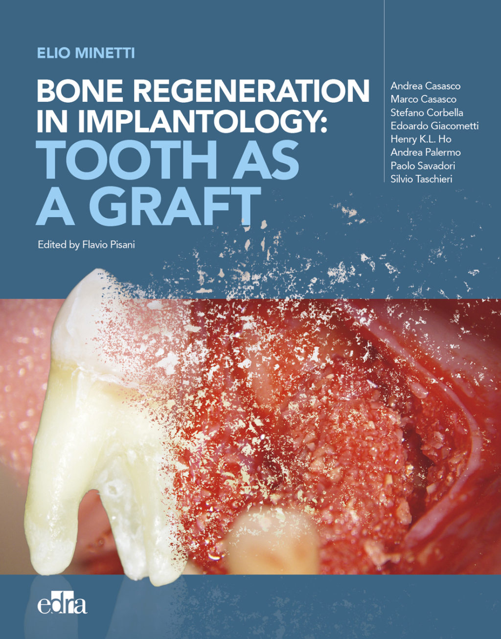 Bone regeneration in implantology:tooth as a graft 1st Edition â€“ PDF ...