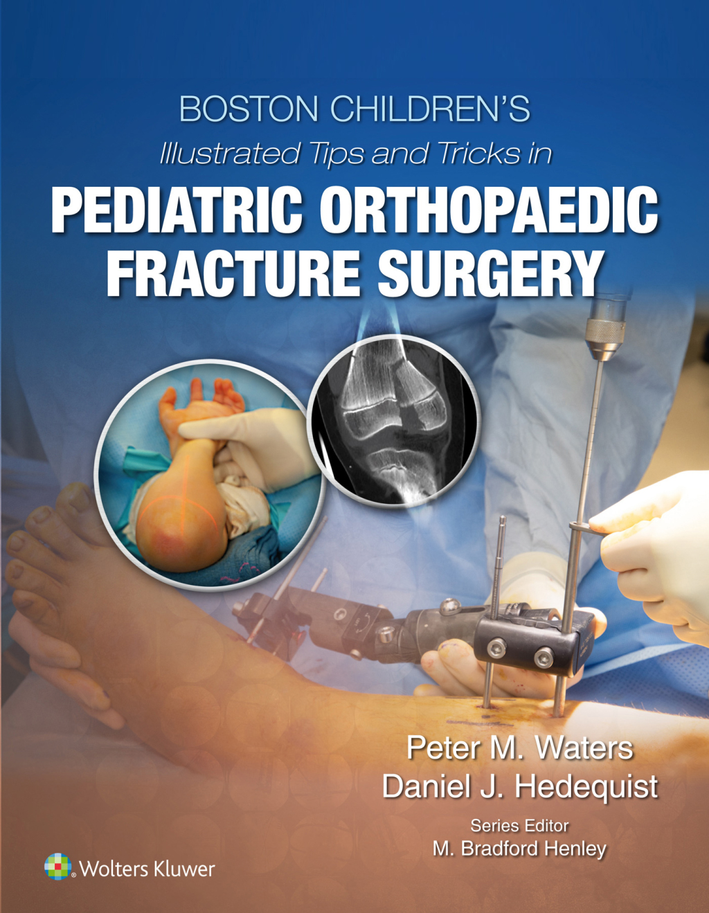 Boston Childrenâ€™s Illustrated Tips and Tricks in Pediatric Orthopaedic Fracture Surgery â€“ PDF/EPUB Version Downloadable