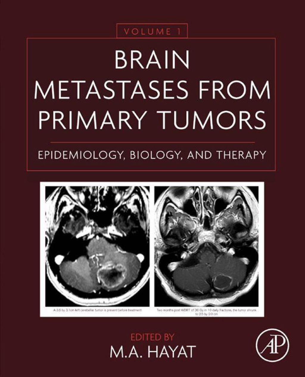 Brain Metastases from Primary Tumors: Epidemiology, Biology, and Therapy â€“ PDF/EPUB Version Downloadable