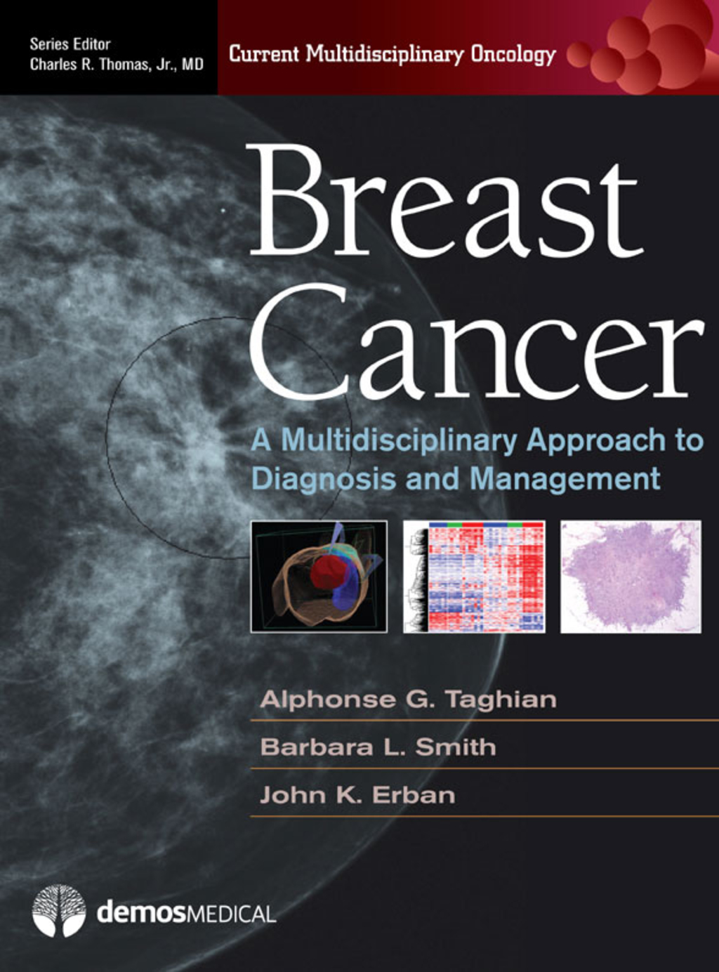 Breast Cancer A Multidisciplinary Approach to Diagnosis and Management 1st Edition â€“ PDF/EPUB Version Downloadable