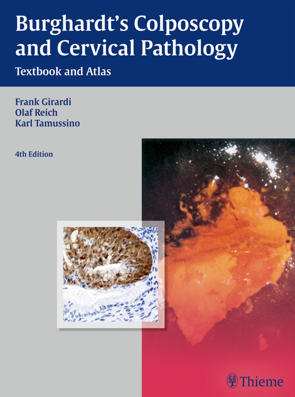 Burghardt’s Colposcopy and Cervical Pathology Textbook and Atlas 4th ...