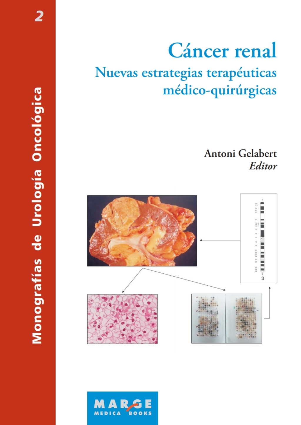 CÃ¡ncer renal. Nuevas estrategias terapeuticas medico-quirurgicas 1st Edition - (PDF/EPUB Version)