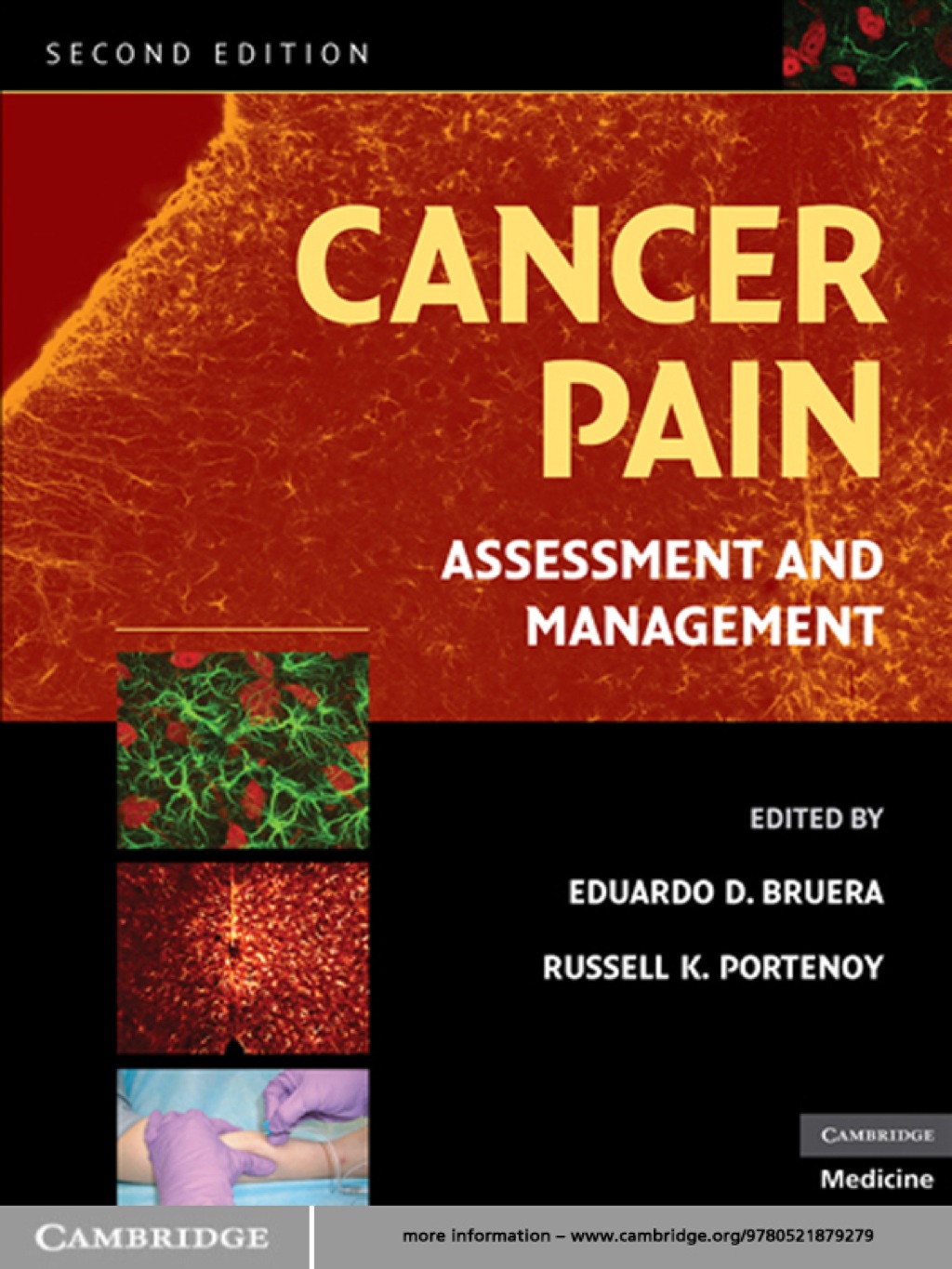 Cancer Pain Assessment and Management 2nd Edition â€“ PDF/EPUB Version Downloadable
