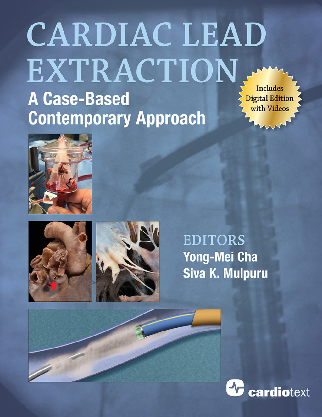Cardiac Lead Extraction: A Case-Based Contemporary Approach â€“ PDF/EPUB Version Downloadable