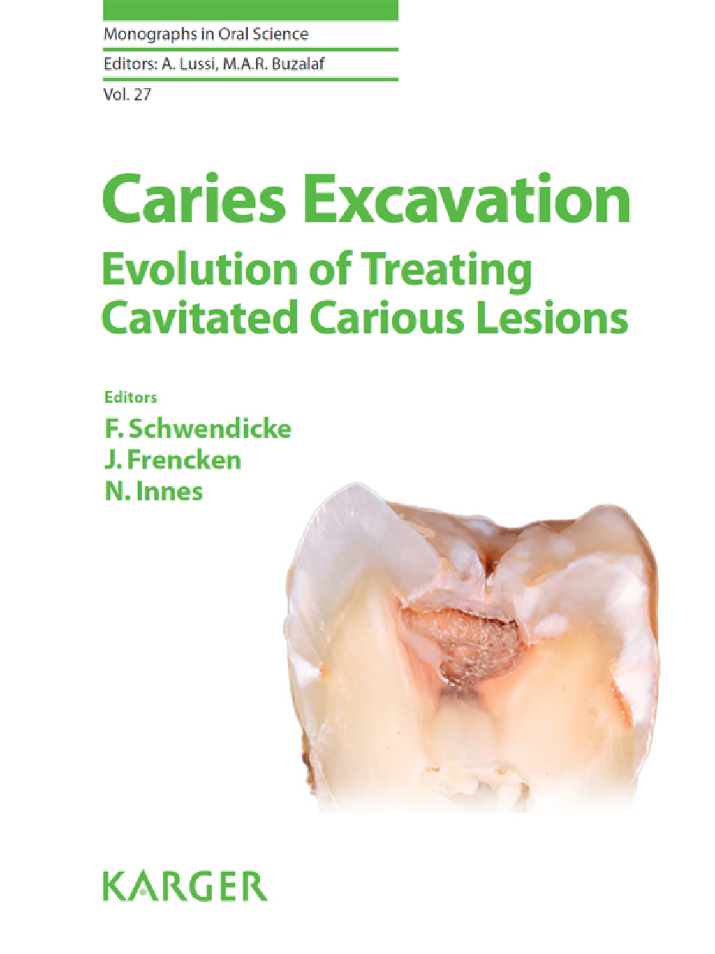 Caries Excavation: Evolution of Treating Cavitated Carious Lesions 1st Edition â€“ PDF/EPUB Version Downloadable