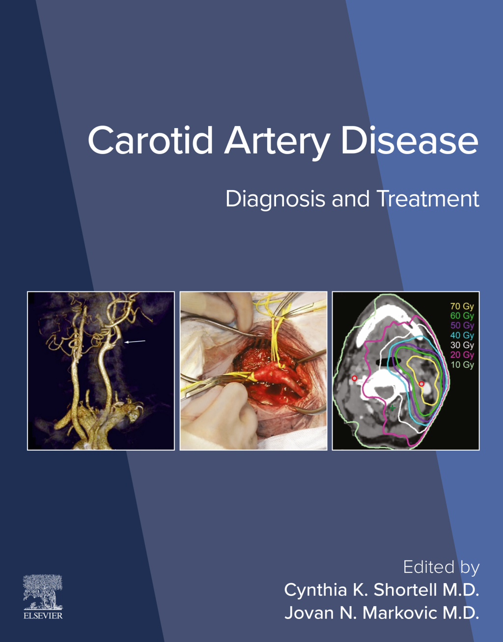 Carotid Artery Disease Diagnosis and Treatment â€“ PDF/EPUB Version Downloadable