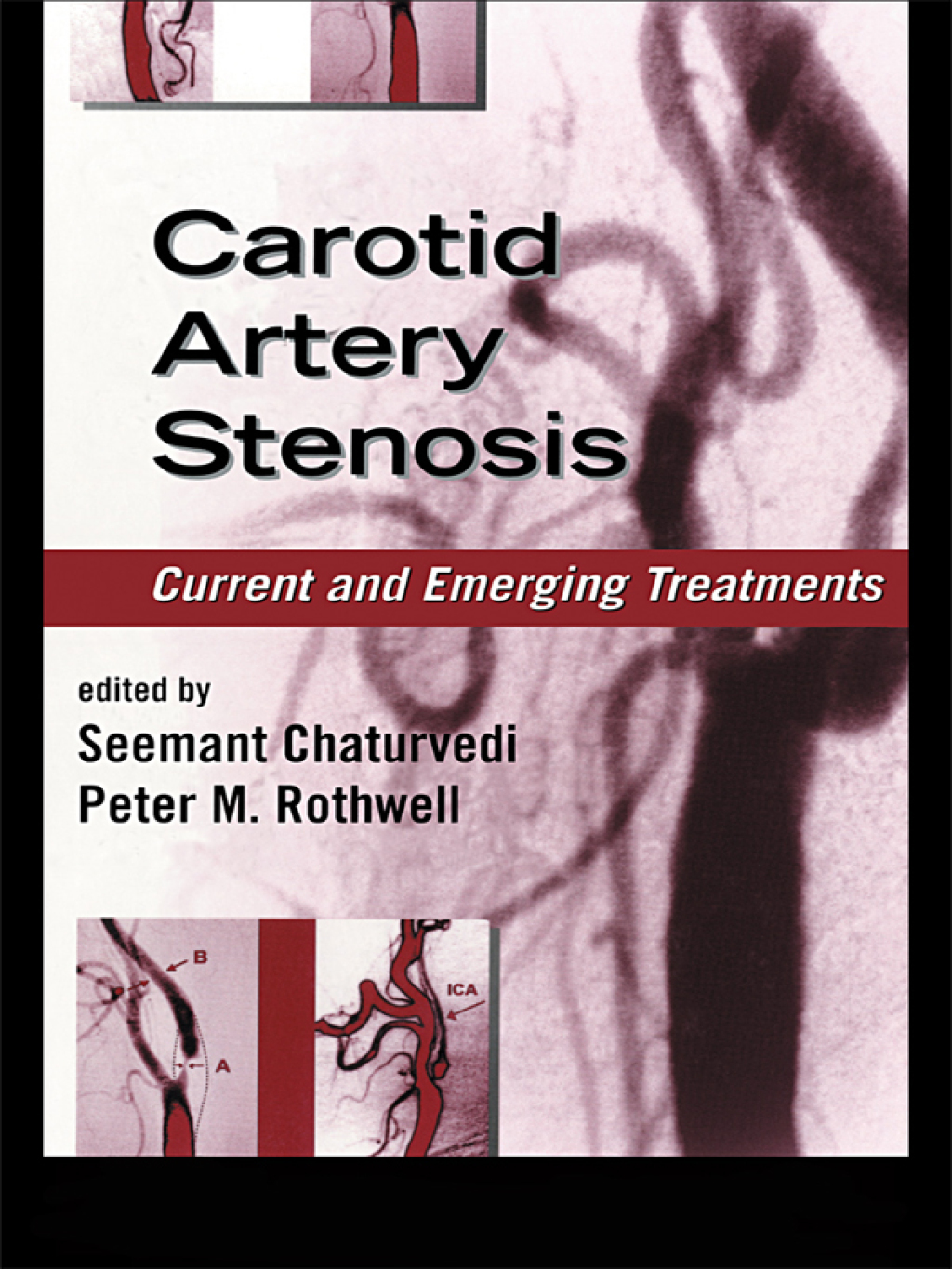 Carotid Artery Stenosis Current and Emerging Treatments 1st Edition â€“ PDF/EPUB Version Downloadable