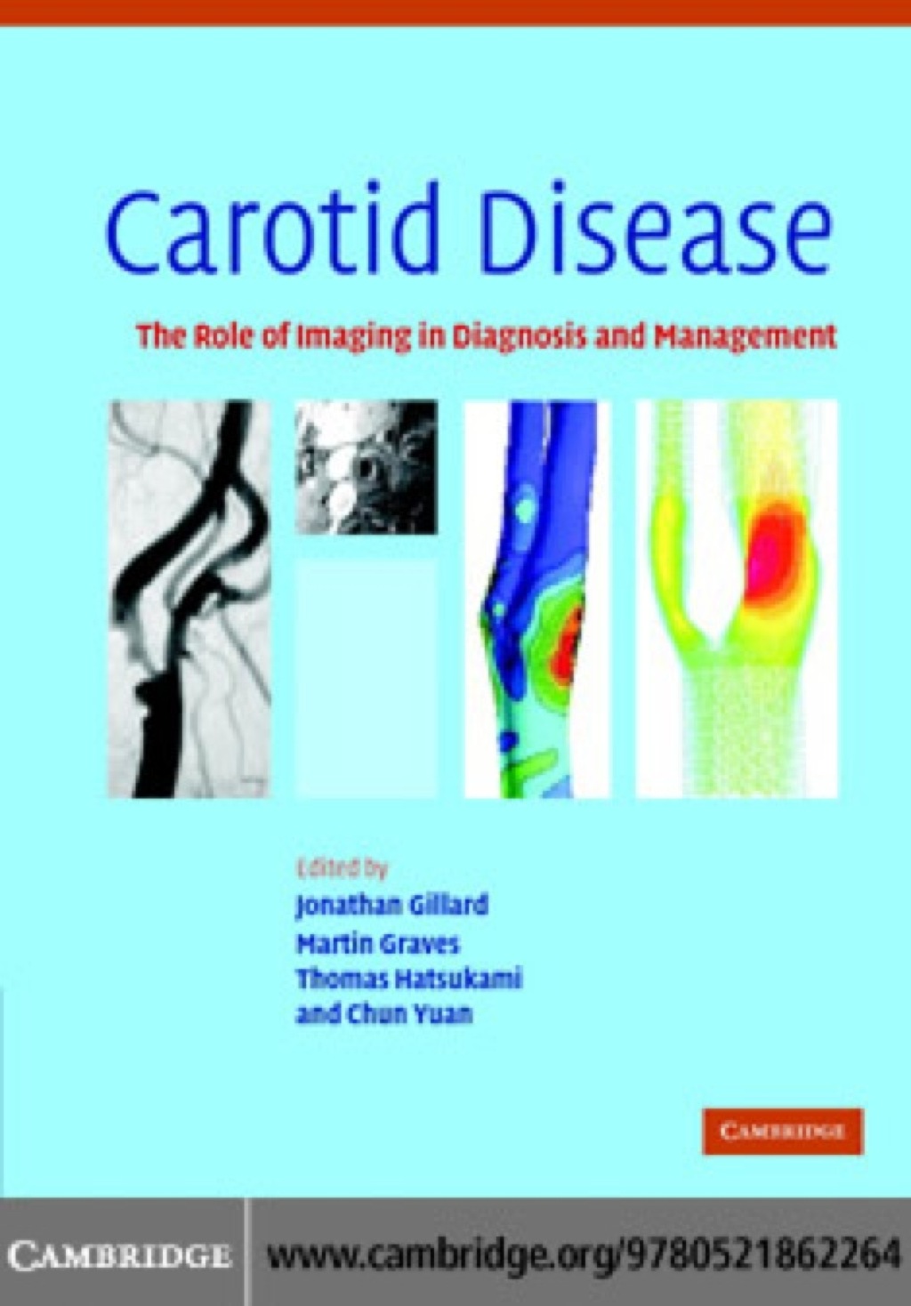 Carotid Disease The Role of Imaging in Diagnosis and Management 1st Edition â€“ PDF/EPUB Version Downloadable