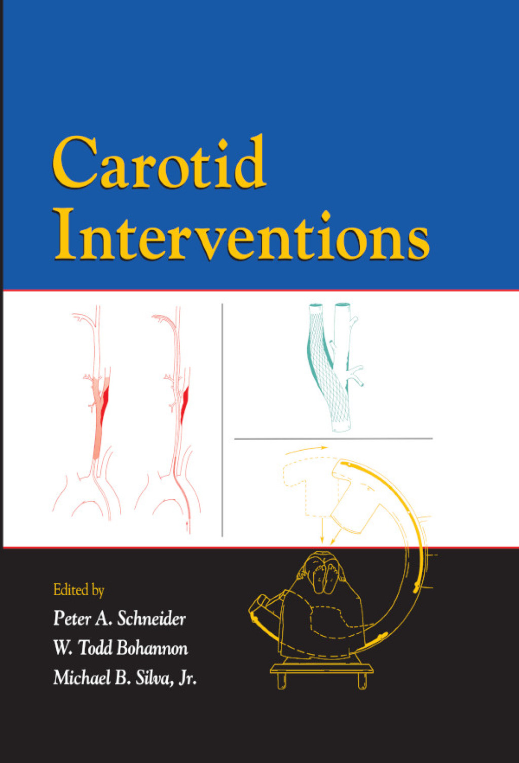 Carotid Interventions 1st Edition â€“ PDF/EPUB Version Downloadable