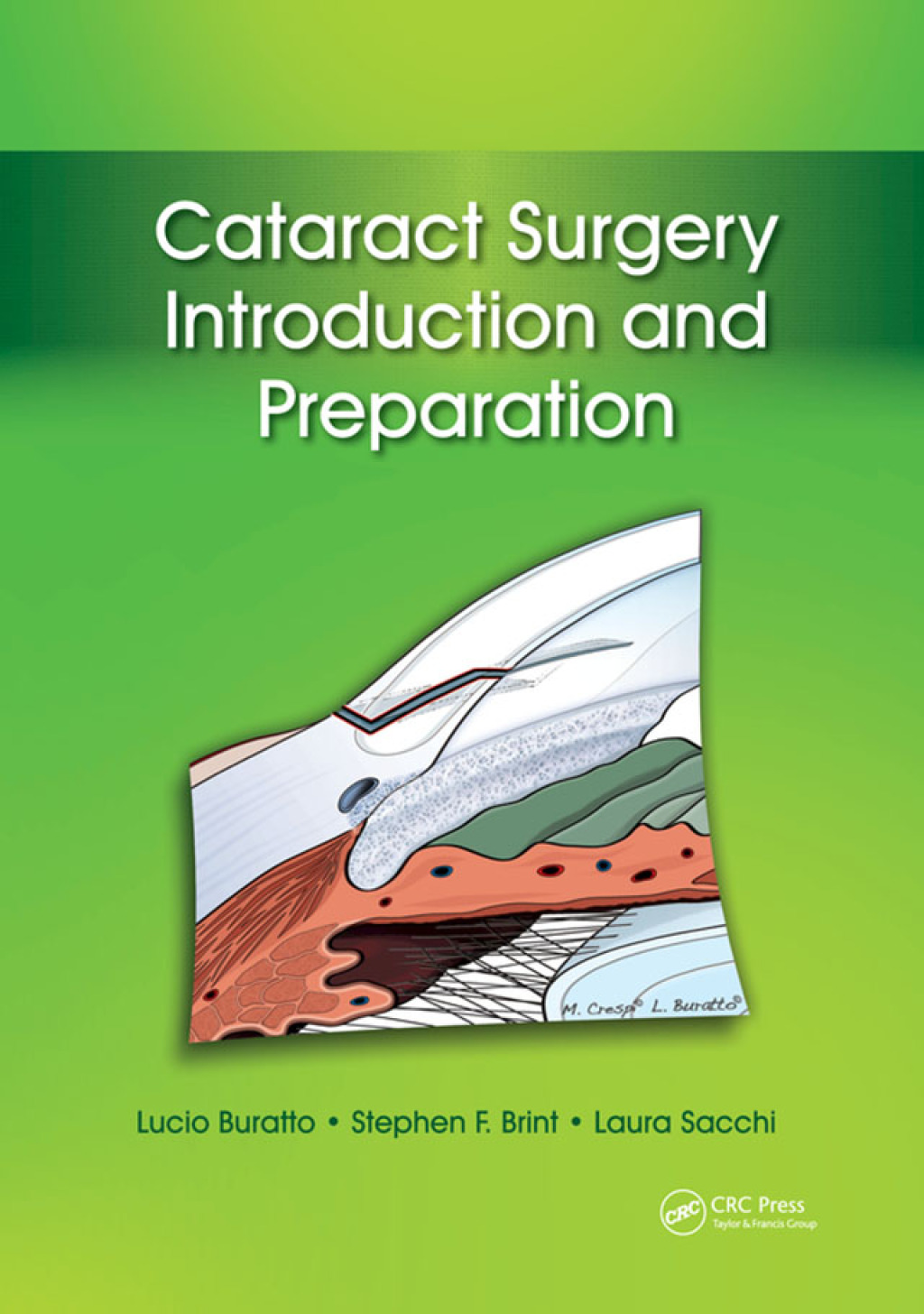 Cataract Surgery Introduction and Preparation 1st Edition â€“ PDF/EPUB ...