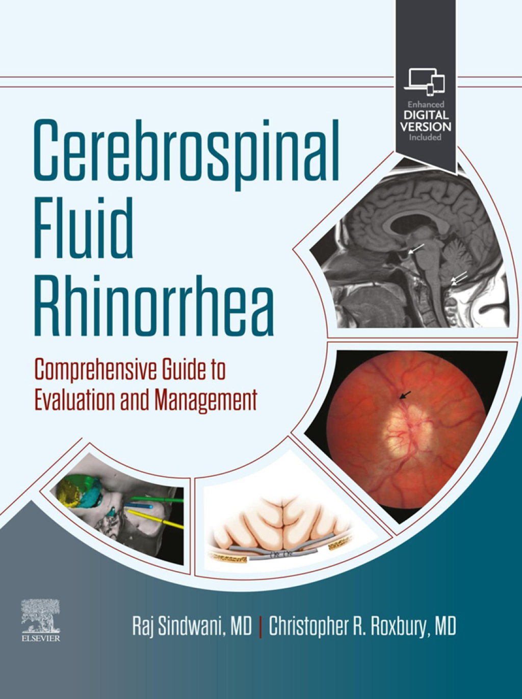 Cerebrospinal Fluid Rhinorrhea Comprehensive Guide to Evaluation and Management 1st Edition â€“ PDF/EPUB Version Downloadable