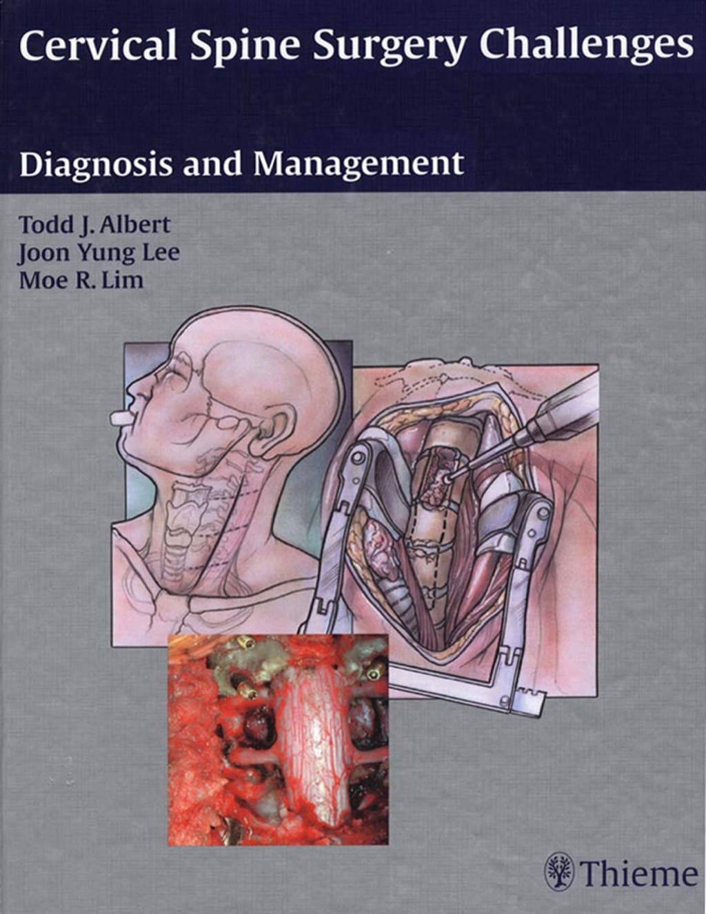 Cervical Spine Surgery Challenges: Diagnosis and Management 1st Edition â€“ PDF/EPUB Version Downloadable