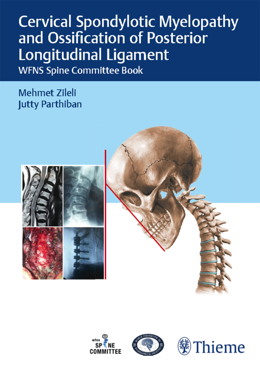 Cervical Spondylotic Myelopathy and Ossification of Posterior Longitudinal Ligament WFNS Spine Committee Book 1st Edition â€“ PDF/EPUB Version Downloadable