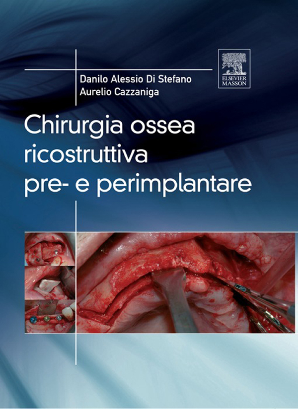 Chirurgia ossea ricostruttiva pre-e perimplantare â€“ PDF/EPUB Version Downloadable
