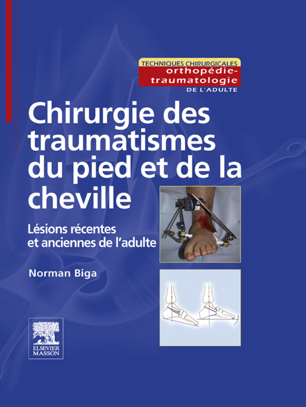 Chirurgie des traumatismes du pied et de la cheville LÃ©sions rÃ©centes et anciennes de l'adulte  â€“ PDF/EPUB Version Downloadable