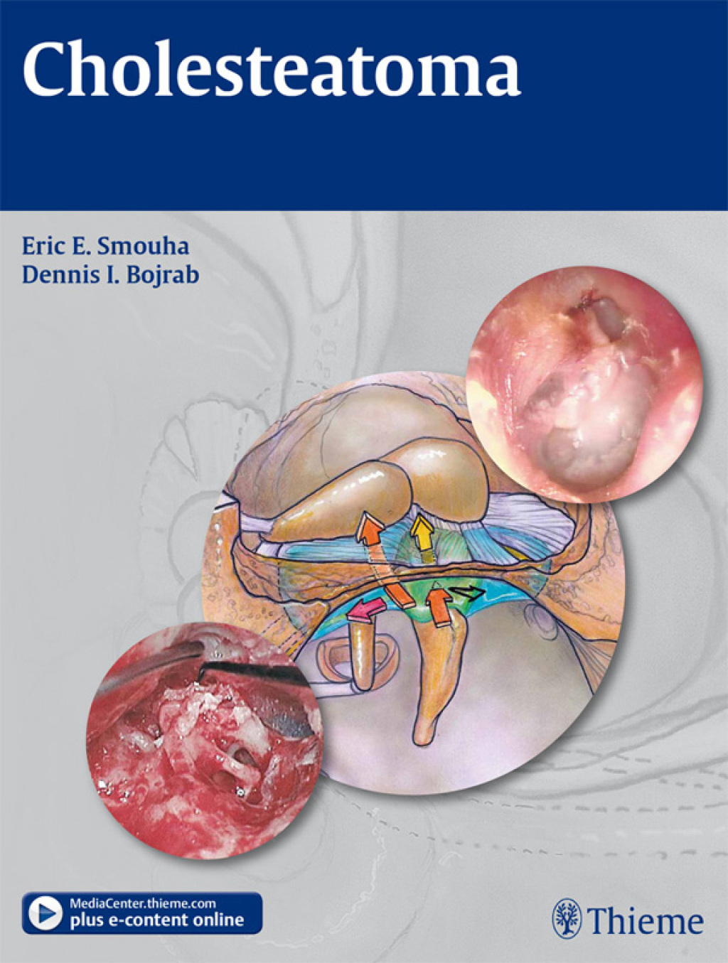 Cholesteatoma 1st Edition â€“ PDF/EPUB Version Downloadable